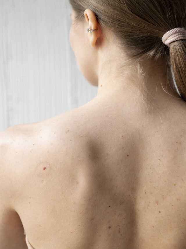 cropped-woman-with-melanoma-her-skin.jpg